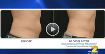 Media Baton Rouge - Dr. Z answers questions about the fat-freezing technique