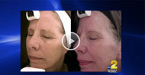 Media Baton Rouge - Laser therapy for reducing wrinkles