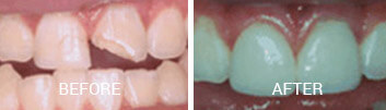 Veneers Before After Closeup