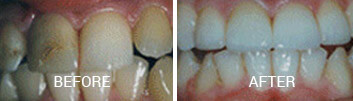Veneers Cary