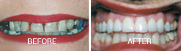 Veneers Treatment