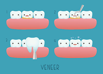 Porcelain Veneers Cary, NC