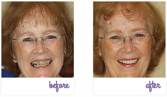 Dentist West Chester - Porcelain Crowns 01