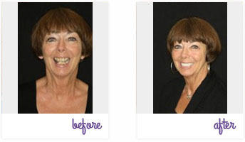 Dentist West Chester - Porcelain Crowns 02
