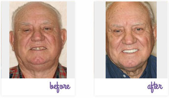 Dentist West Chester - Porcelain Crowns 03