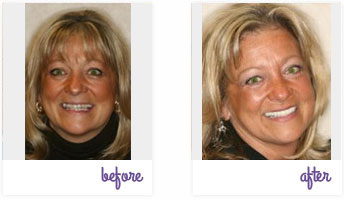 Dentist West Chester - Porcelain Crowns 04
