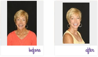 Porcelain Veneers West Chester - Porcelain Veneers 02