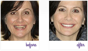 Porcelain Veneers West Chester - Porcelain Veneers 04