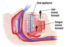 Sleep Apnea West Chester - Snoring device works diagram