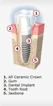 Dental Implants West Chester - Dental Implants