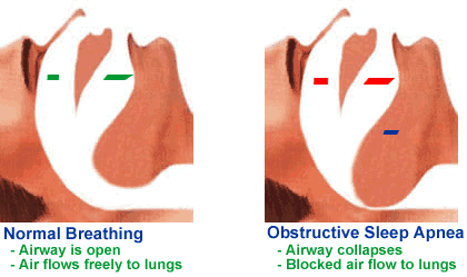 Sleep Apnea West Chester - Obstructive sleep apnea