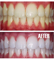 Teeth Whitening West Chester - Teeth Whitening 02