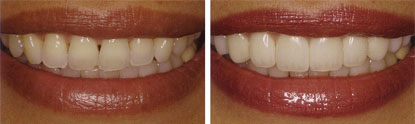 Porcelain Veneers West Chester - Porcelain Veneers image 02