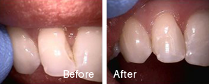 Before and After2