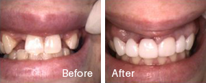 Before and After9
