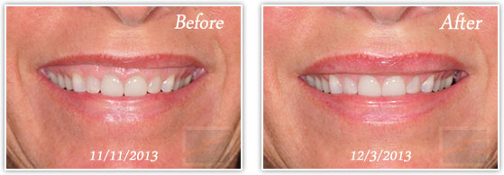 Botox for Gummy Smile, Before and After