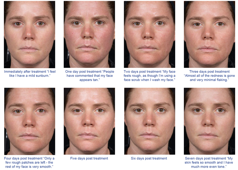 Clear and Brilliant Recovery Process