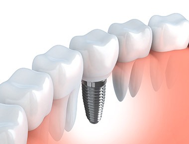 Dental Implants Bloomington