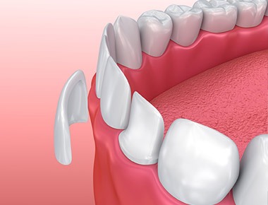 Dental Veneers Bloomington