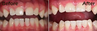 Cosmetic Bonding, Bloomington