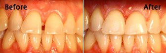 Diastema Bonding, Bloomington