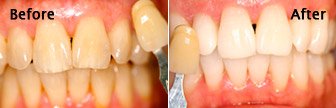 KOR Tooth Whitening, Bloomington