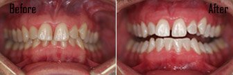 Zoom! Whitening, Bloomington