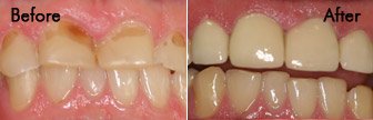 Porcelain Crowns & Composite Fillings, Bloomington