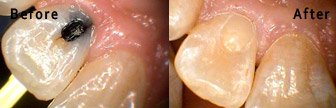 Replaced Silver Filling with Composite Filling, Bloomington