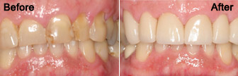 Dental Crowns 01, Bloomington