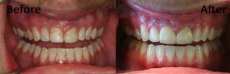 Porcelain Crowns, Bloomington