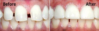 Porcelain Veneers, Bloomington