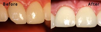 Chipped Tooth, Bloomington