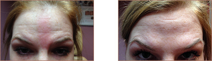 Photo Gallery Lansdale - Before and After 01