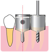 MD Implant Guide Drill - MD Guide Intro kit