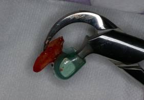 Dental Implants Procedure