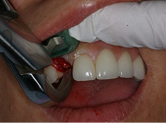 Atraumatic Extraction