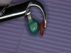 Atraumatic Extraction