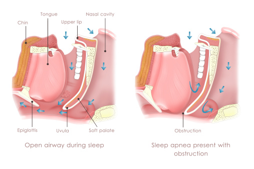 Physics Forceps Series - Continuing Education Courses - Sleep Apnea for Dentists