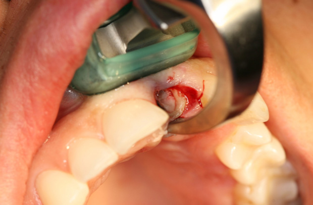 Dental Clinical Videos - Step 1 Image