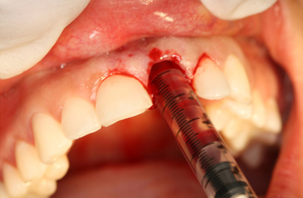 Dental Clinical Videos - Step 2 Image