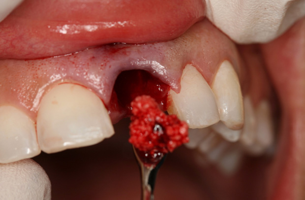 Dental Clinical Videos - Step 4 Image