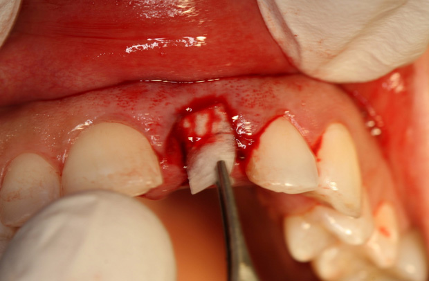Dental Clinical Videos - Step 5 Image
