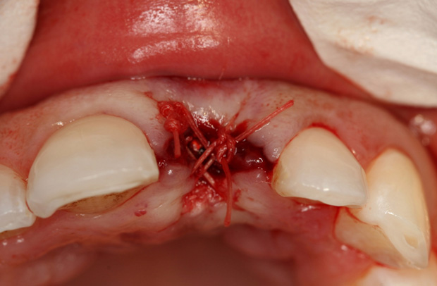 Dental Clinical Videos - Step 6 Image