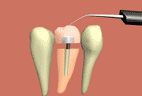 Crown Remover - Ultrasonics