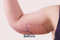 Skin Care Birmingham - Exilis® Laser Treatment  01