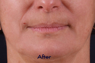 Skin Care Birmingham - Exilis® Laser Treatment  10