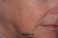 Skin Care Birmingham - Exilis® Laser Treatment  11