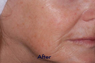 Skin Care Birmingham - Exilis® Laser Treatment  12