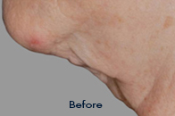 Skin Care Birmingham - Exilis® Laser Treatment  15